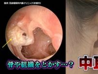 「プールで耳に水が入って中耳炎」間違い？！大人も要注意…放置すると危険な“中耳炎”　骨や組織を溶かすことも